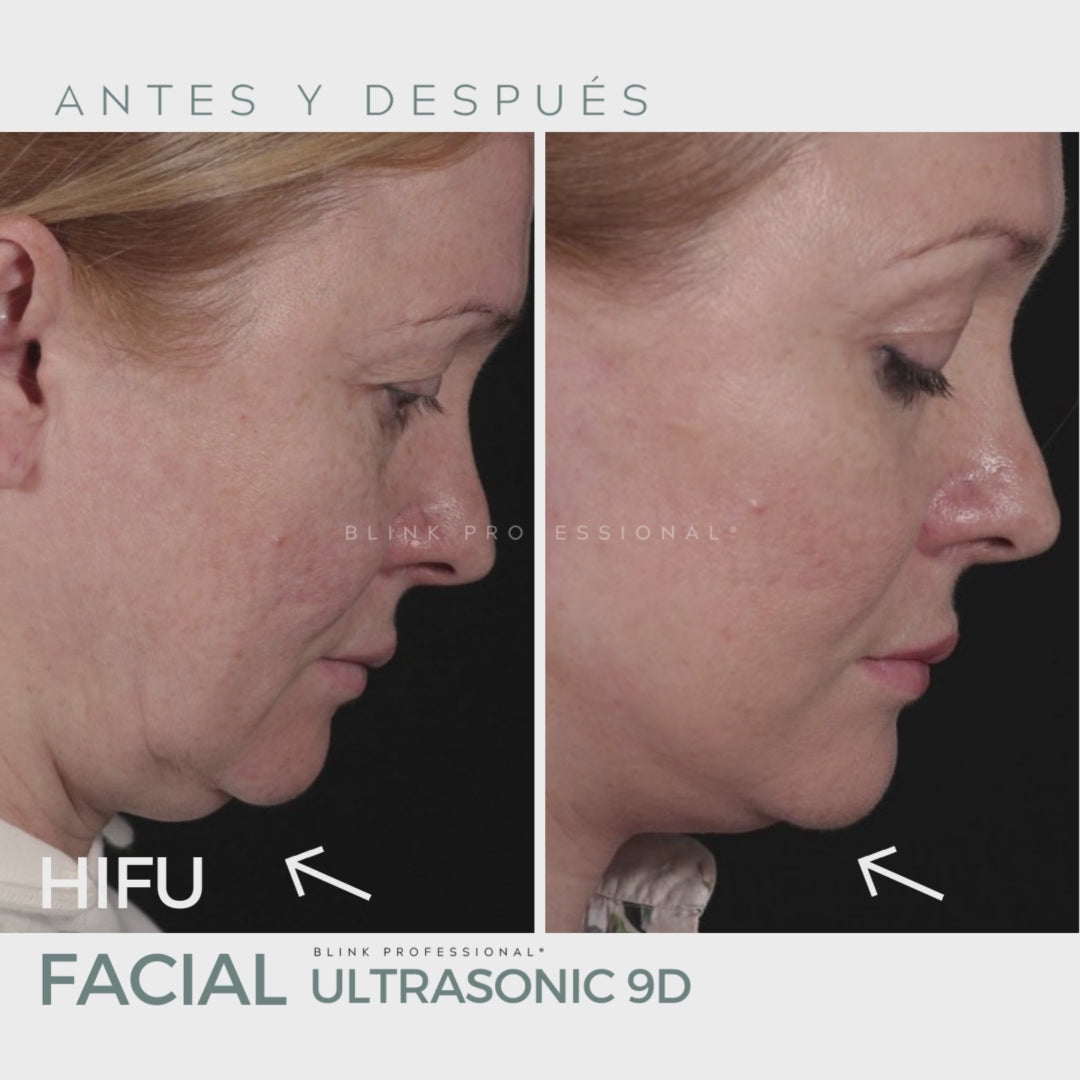 Ultrasonic 9D (Nuevo)