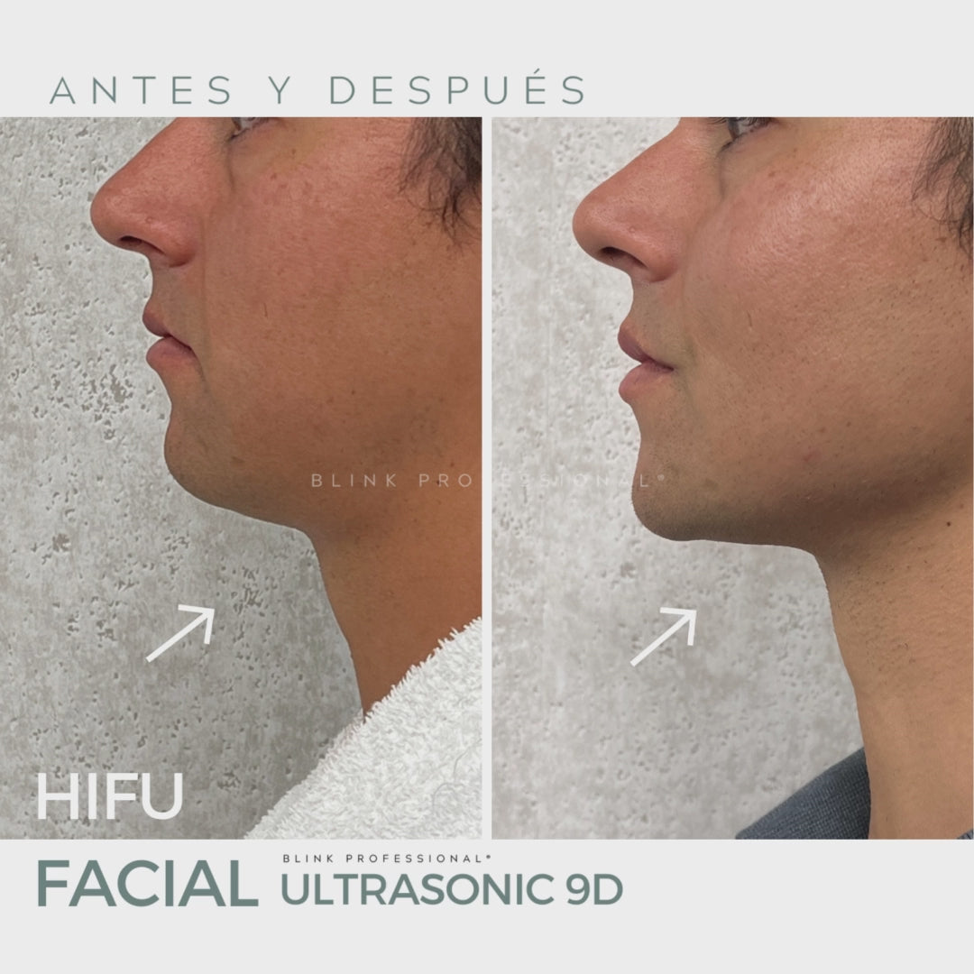 Ultrasonic 9D (Nuevo)