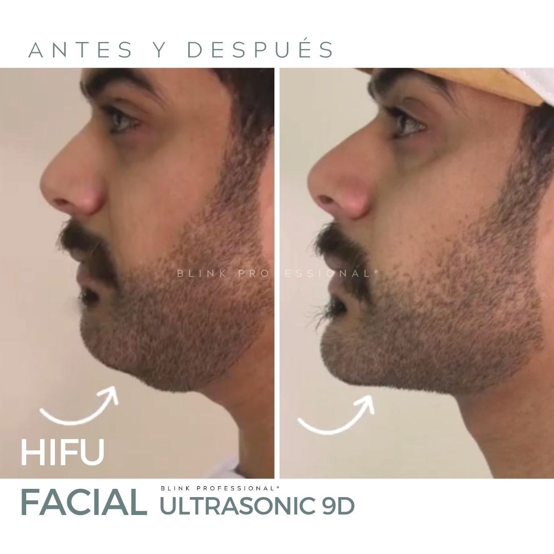 Ultrasonic HIFU 9D (Nuevo)